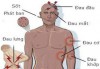Hình 1: Những dấu hiệu biểu hiện của bệnh Sốt xuất huyết. Ảnh minh họa