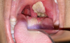 Xuất hiện giả mạc tại vùng hầu họng là triệu chứng điển hình của bệnh bạch hầu.