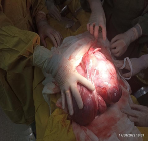 Hình  ảnh các y, bác sĩ Bệnh viện Sản Nhi tỉnh   phẩu thuật lấy khối u xơ tử cung  nặng gần 4,5kg.